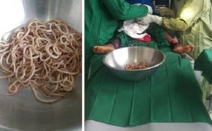 Camerun, a 4 anni è pieno di vermi nello stomaco: i medici glieli rimuovono FOTO