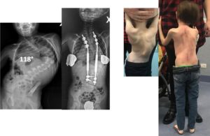 Scoliosi rara, bimba operata a Torino: barre magnetiche per correggere