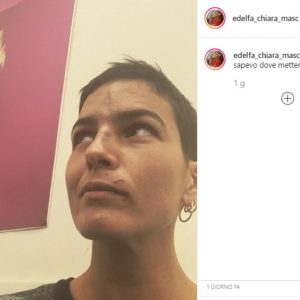 Edelfa Chiara Masciotta e la foto delle cicatrici su Instagram dopo l'incidente