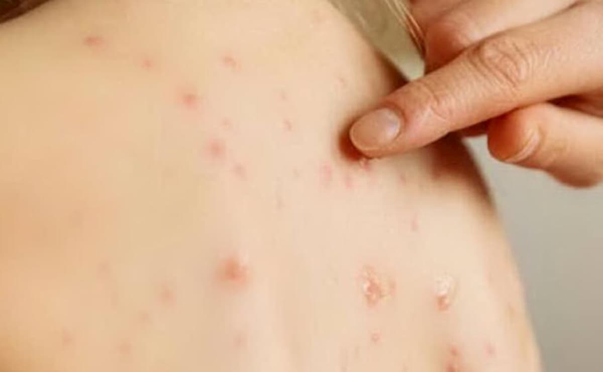 Coronavirus, potrebbe esserci un nesso con alcune irritazioni della pelle