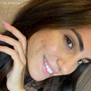 Giulia De Lellis mostra l'acne su Instagram