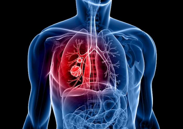 Tumore al polmone, perché alcuni pazienti non rispondono all'immunoterapia