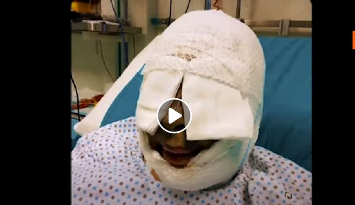 Gessica Notaro mostra per la prima volta il volto deturpato dall'acido gettato dal suo ex VIDEO