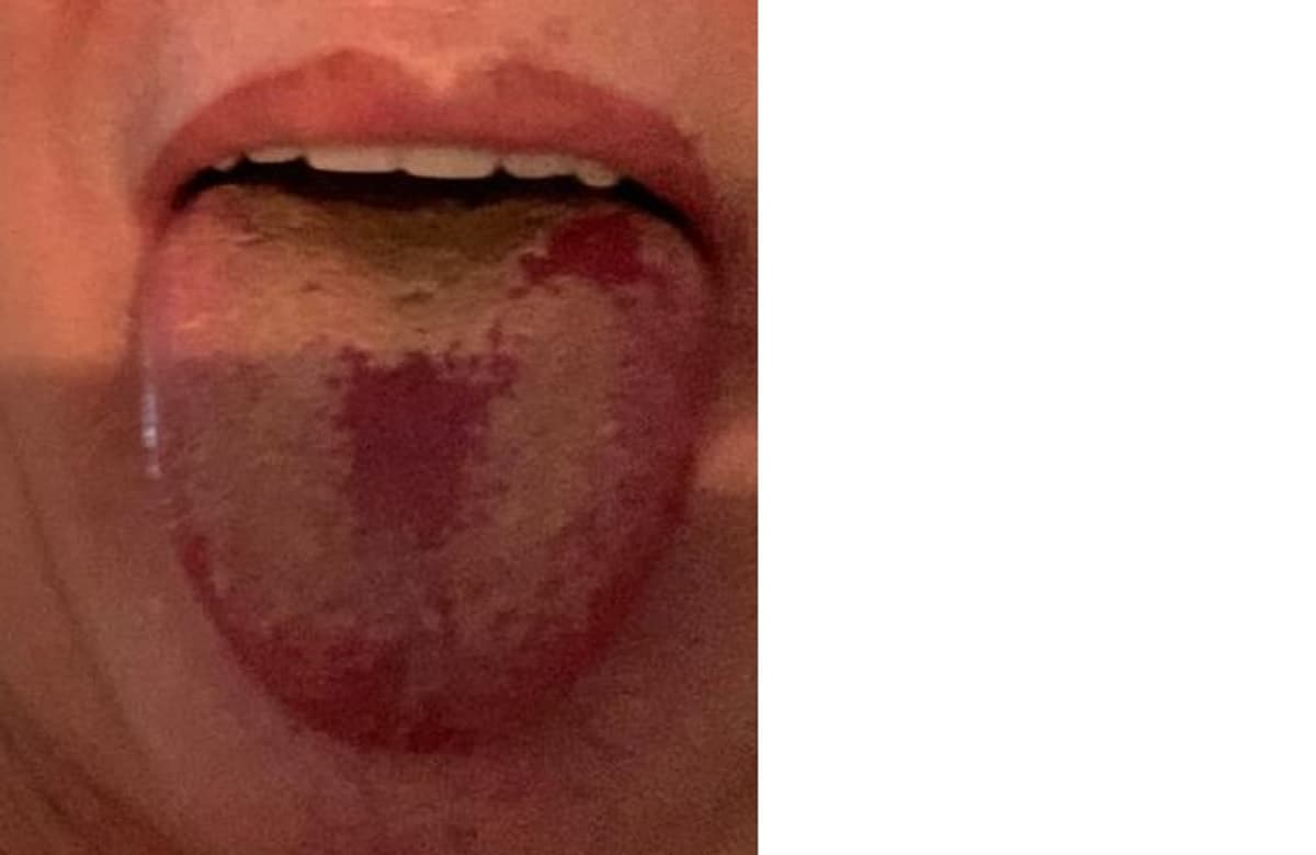 Lingua da Covid, nuovo sintomo che provoca ulcere, gonfiore e macchie bianche in bocca