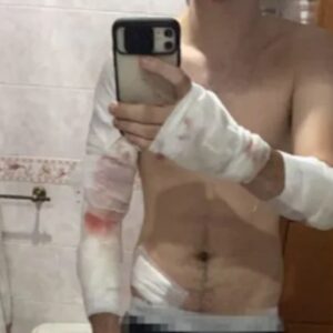 Napoli, ragazzo di 21 anni pestato a sangue per rubargli lo scooter: lui posta la foto delle ferite