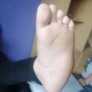 Piede torto, appello ai genitori della undicenne cui vogliono amputare la gamba: metodo Ponseti senza chirurgia