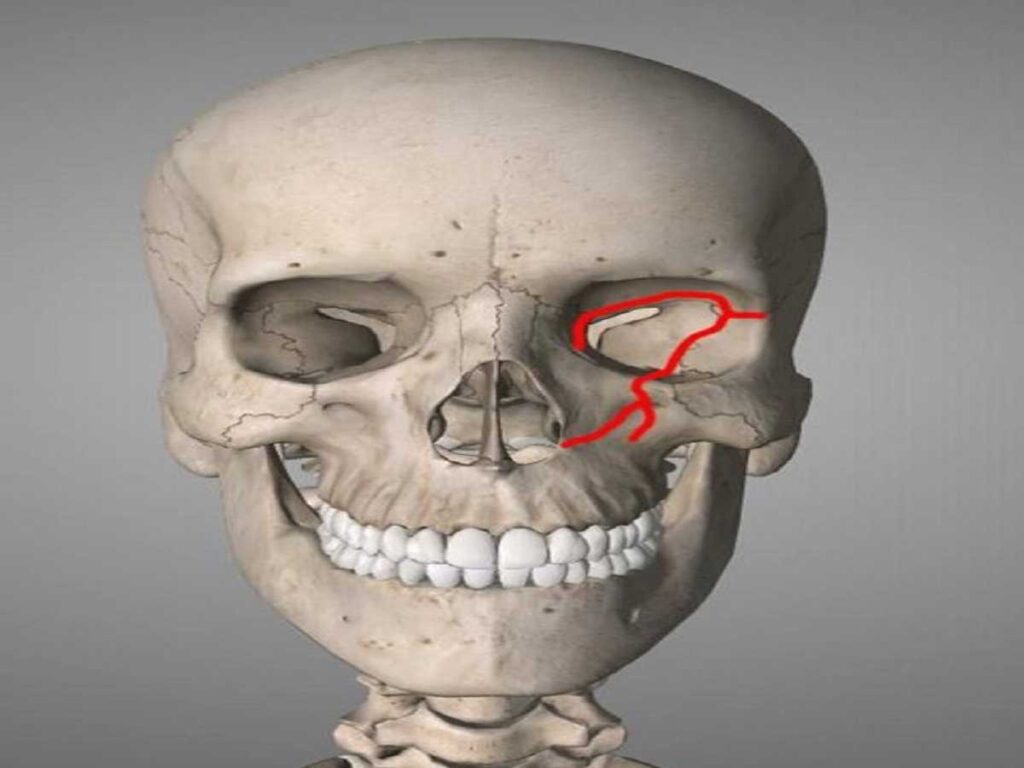 Le fratture del cranio nella parte frontale