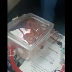 "Cuore in scatola" tenuto in vita, continua a battere: il primo trapianto in Italia VIDEO