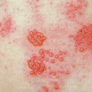 La pelle manda segnali, non trascurateli: dal fuoco di S.Antonio alla meningite, ecco 9 malattie
