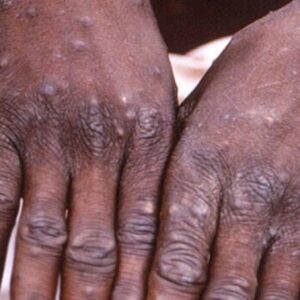 Le mani di un malato di vaiolo delle scimmie, l'altra epidemia è la pertosse