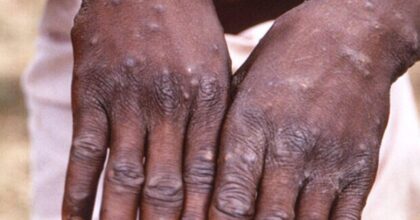 Le mani di un malato di vaiolo delle scimmie, l'altra epidemia è la pertosse